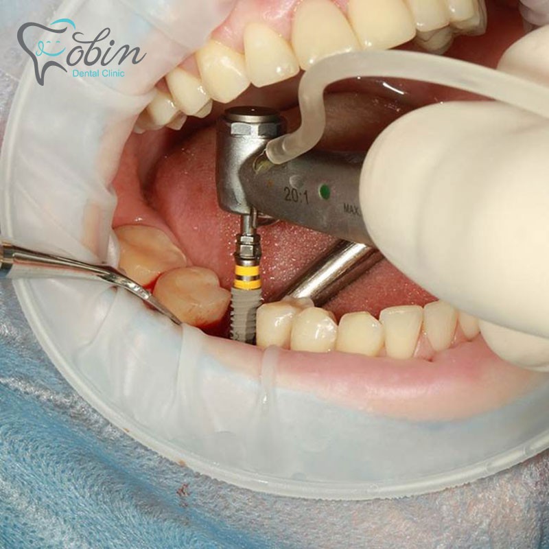 شرح روش های ایمپلنت دندان